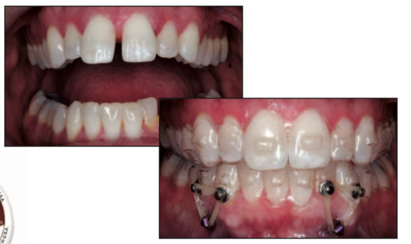 Perfect-A-Smile Aligner Pontic Paint