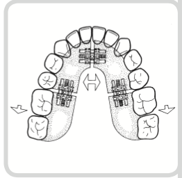 Universal Expansion Screw