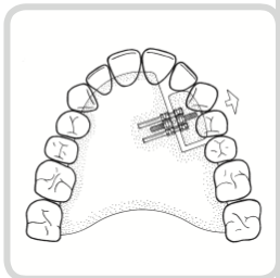 Universal Expansion Screw
