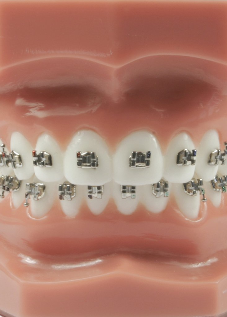 Evolve Orthodontic Metal Brackets