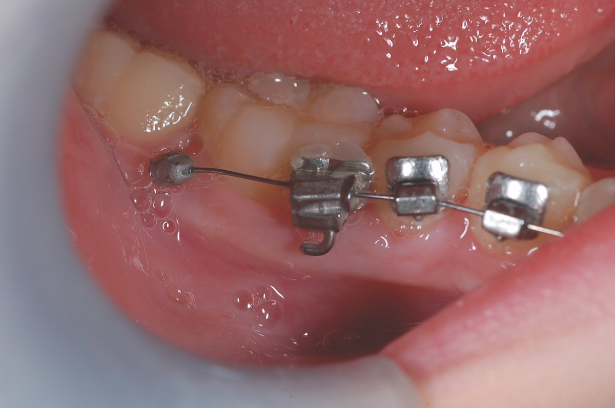 Ixion Safe Cinch Plier