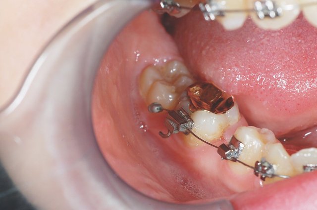 Ixion Safe Cinch Plier