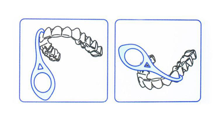 How to use aligner removal tool