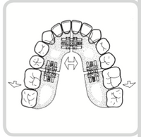 Universal Expansion Screw
