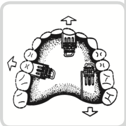 Skeletal Sector Expansion Screws