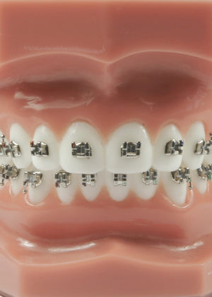 Evolve Orthodontic Metal Brackets