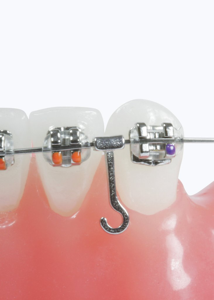 Crimpable Archwire Hooks