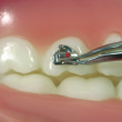 Ixion Lingual Bracket and Bondable Tube Holder