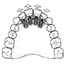 Micro Protrusion Screws